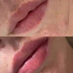 lipfiller-door-ayshclinic